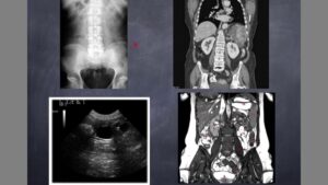 Collage de imágenes médicas para diagnóstico por imagen que muestra una radiografía anteroposterior de pelvis y columna lumbar, cortes coronales de tomografía computarizada y resonancia magnética del abdomen y pelvis con anotaciones y una imagen ecográfica en blanco y negro, ideal para ilustrar comparativas y contenidos sobre Ecografía o ultrasonido ventajas y desventajas: guía completa y segura.
