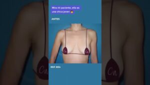 Fotografía frontal del torso de una paciente joven sobre fondo azul que muestra el pecho cubierto con un pequeño bikini triangular, con texto superpuesto que dice "Mira mi paciente, ella es una chica joven" y la palabra "ANTES" visible, diseñada como imagen comparativa estética y orientada a Mujeres con senos grandes ventajas y desventajas que debes conocer.