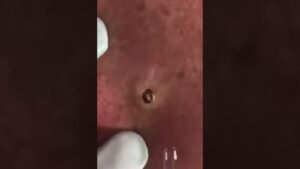 Primer plano de piel enrojecida con un punto oscuro similar a un comedón en proceso de extracción, manos con guantes y una herramienta de extracción visibles, QLED vs OLED ventajas y desventajas: cuál pantalla elegir