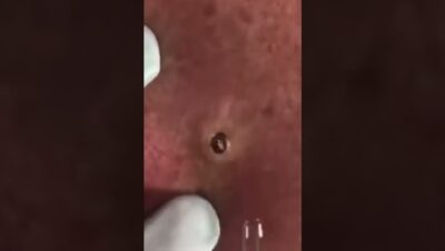 Primer plano de piel enrojecida con un punto oscuro similar a un comedón en proceso de extracción, manos con guantes y una herramienta de extracción visibles, QLED vs OLED ventajas y desventajas: cuál pantalla elegir