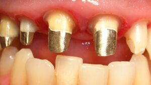 Fotografía intraoral en primer plano que muestra preparaciones dentales con muñones colados metálicos dorados visibles sobre los incisivos superiores y encías ligeramente inflamadas, ideal para ilustrar Perno muñón colado ventajas y desventajas para elegir mejor en contenidos sobre prótesis y restauración dental.