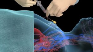 Ilustración médica que muestra a un profesional con guantes accediendo a un port-a-cath implantado en el pecho de un paciente mediante una aguja Huber conectada al reservorio subcutáneo y al catéter venoso central, con representación transparente de venas y arterias durante un procedimiento de infusión o extracción de sangre — Ventajas y desventajas de un port a cath: guía esencial para pacientes.