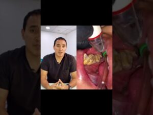 Imagen vertical dividida que muestra a la izquierda a un profesional dental sentado y hablando frente a cámara en un consultorio y a la derecha un primer plano intraoral de un procedimiento de limpieza con un aplicador ultrasónico y succión removiendo sarro de molares, ilustrando Ventajas y desventajas del ultrasonido dental para ti